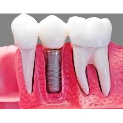 implanturi dentare Bucuresti